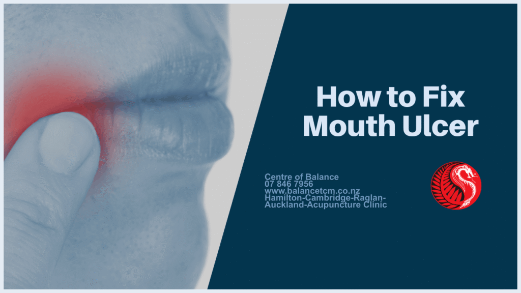acupoints for mouth ulcer